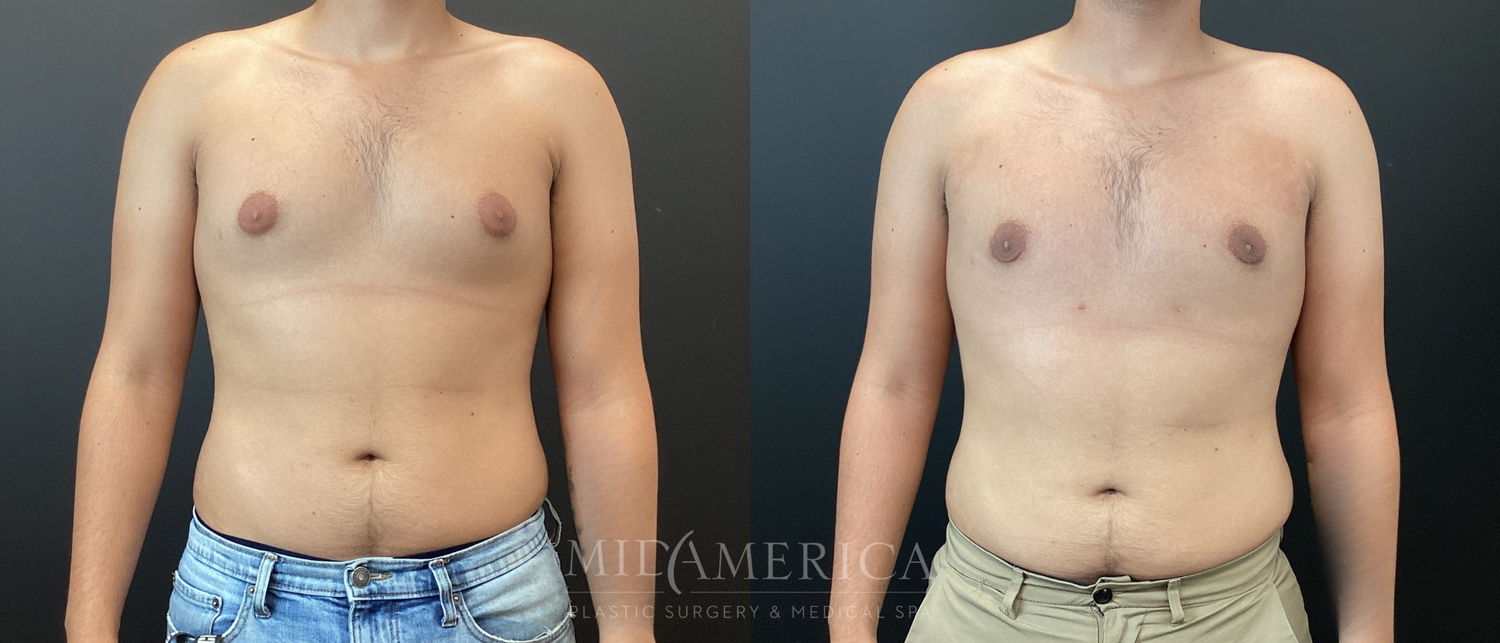 Gynecomastia Before & After