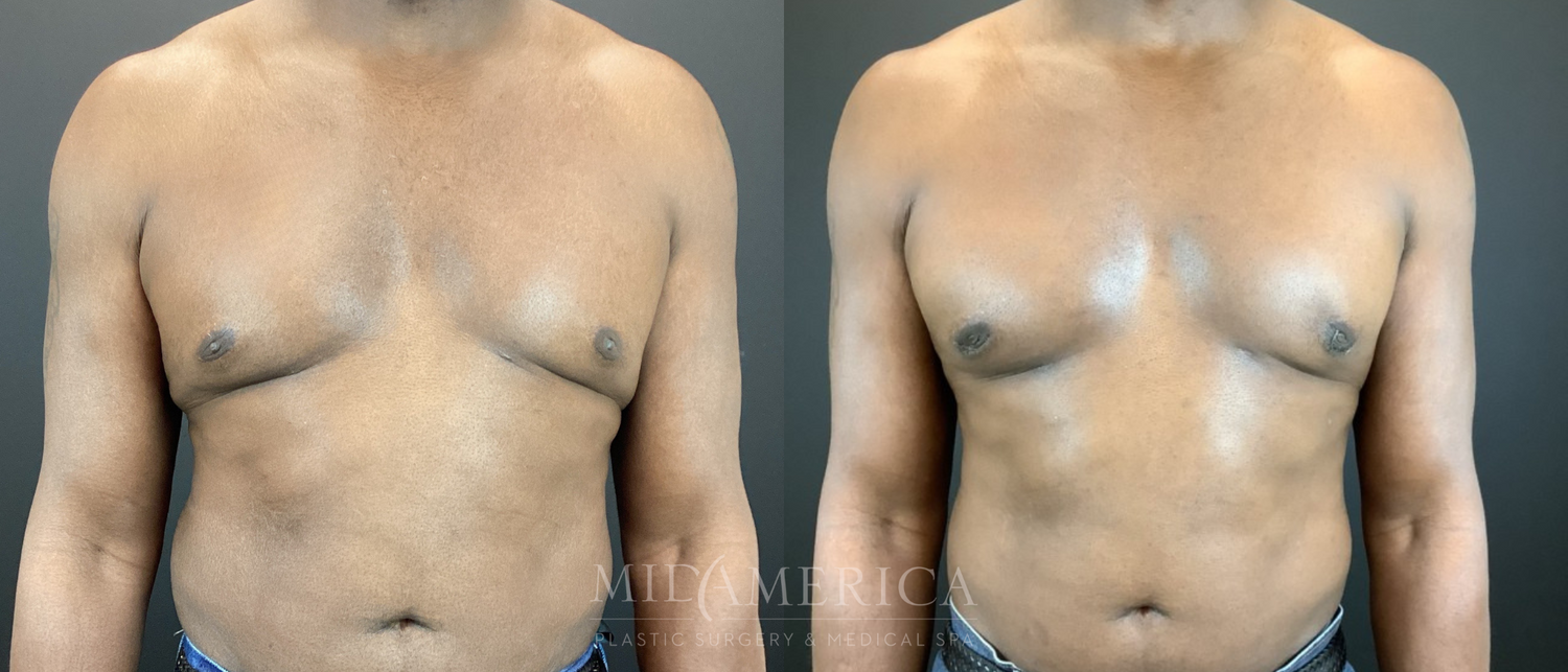 Gynecomastia Before & After