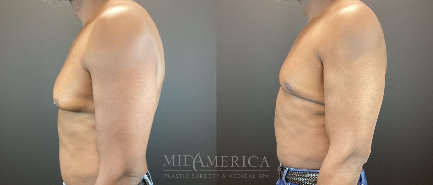 Gynecomastia Before & After
