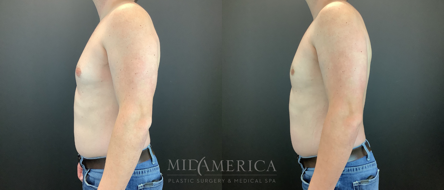 Gynecomastia Before & After