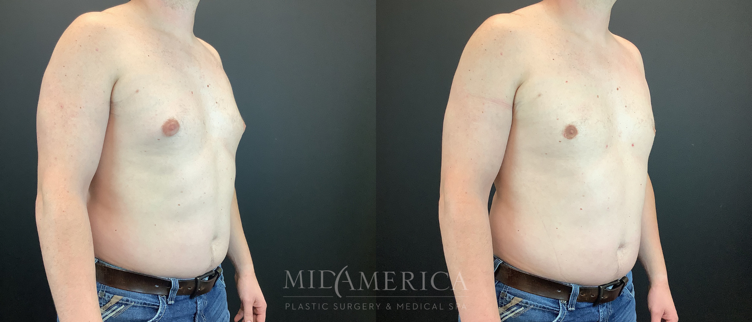 Gynecomastia Before & After