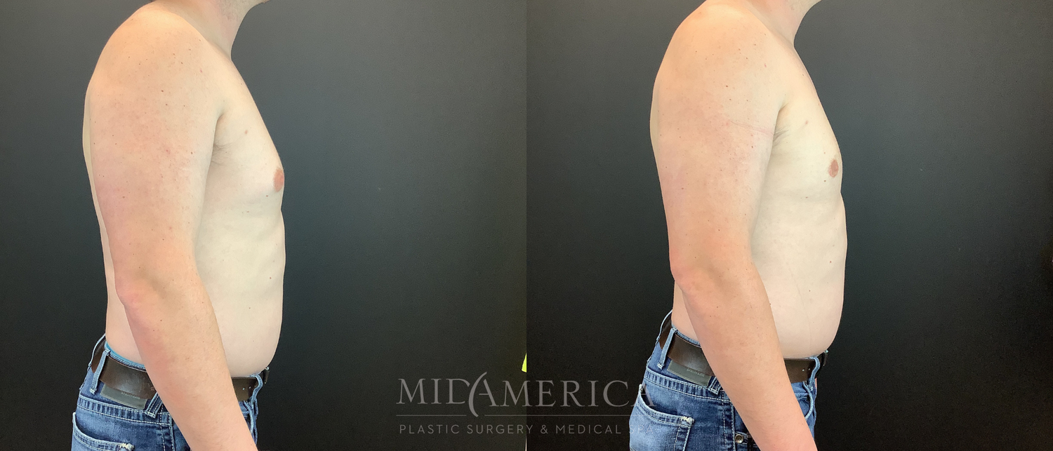 Gynecomastia Before & After