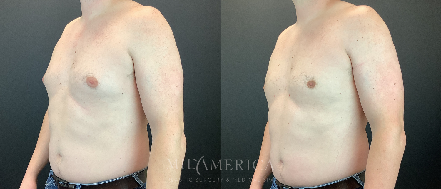 Gynecomastia Before & After