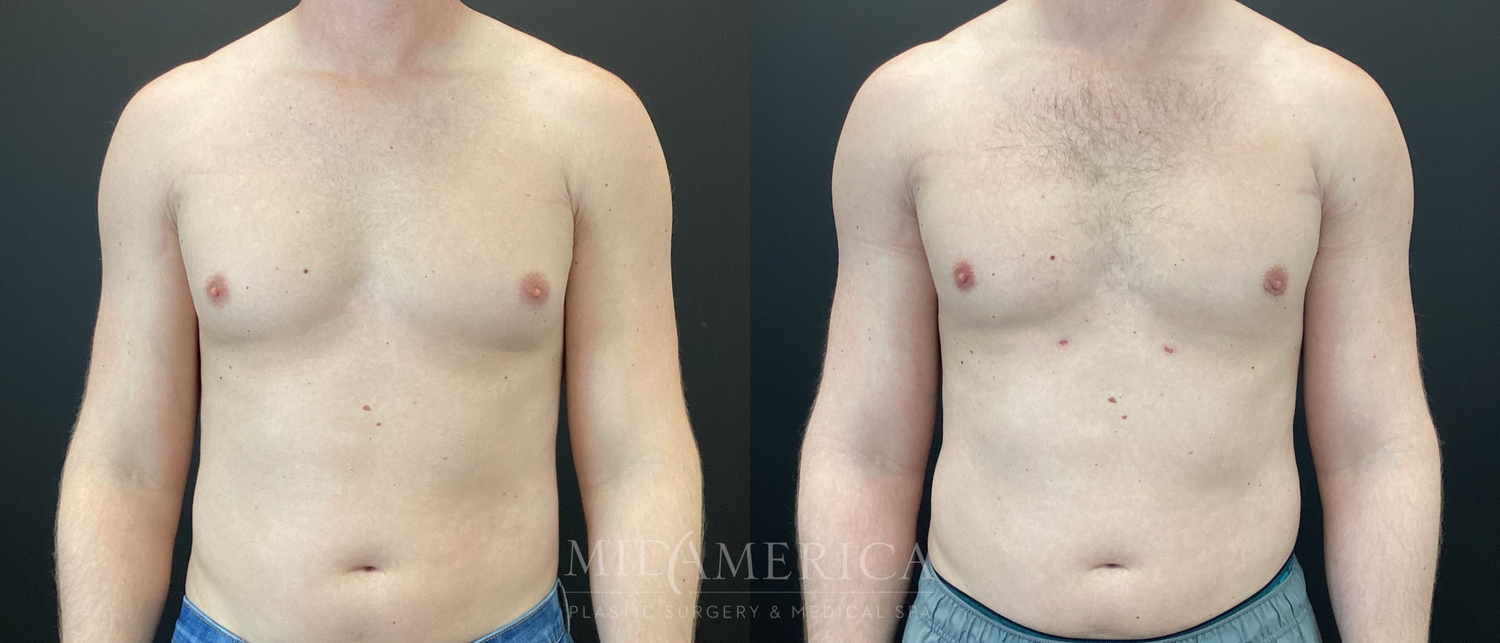 Gynecomastia Before & After