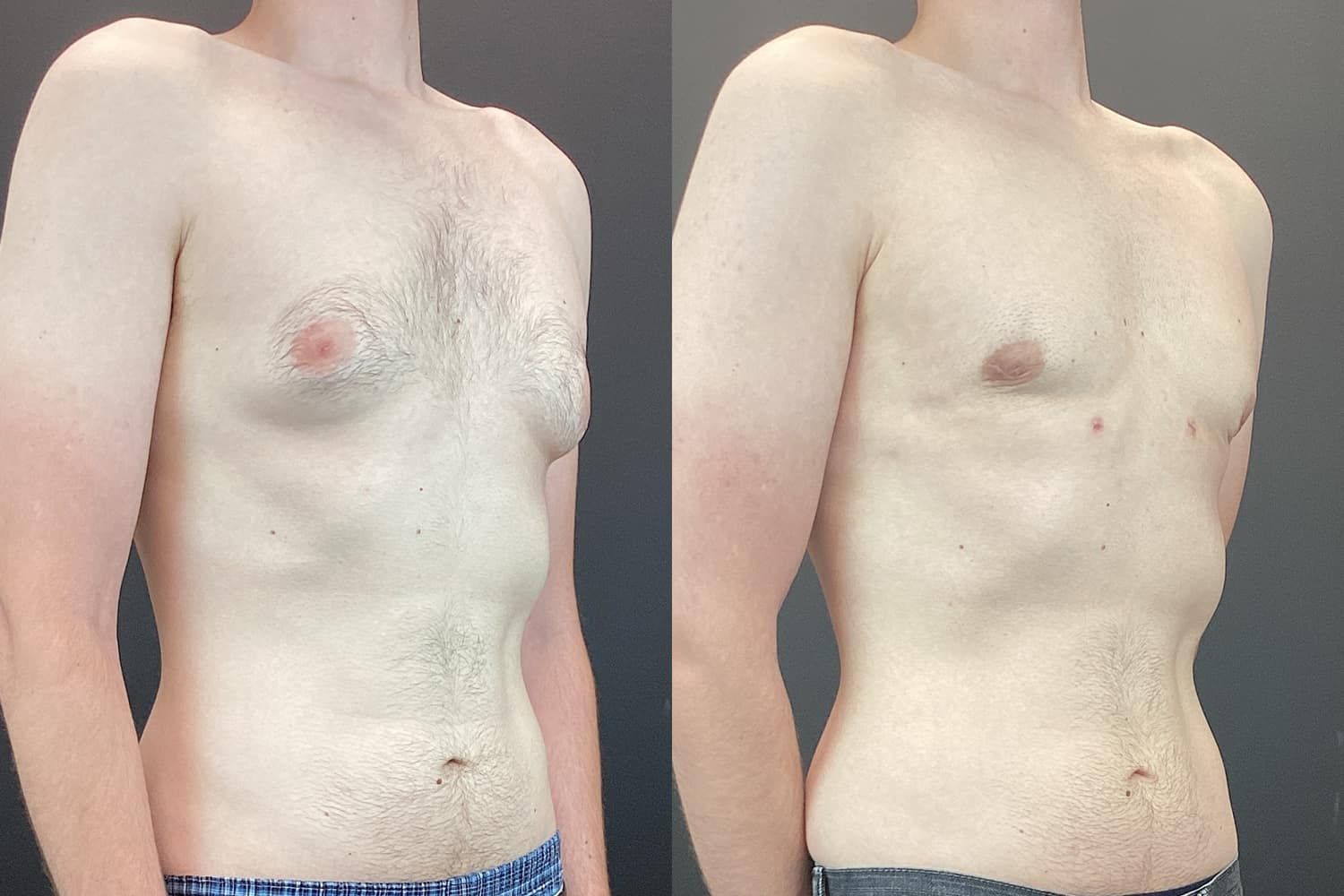 Gynecomastia Before & After
