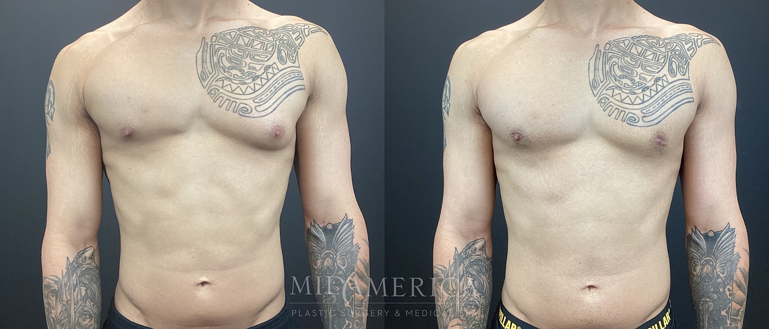 Gynecomastia Before & After