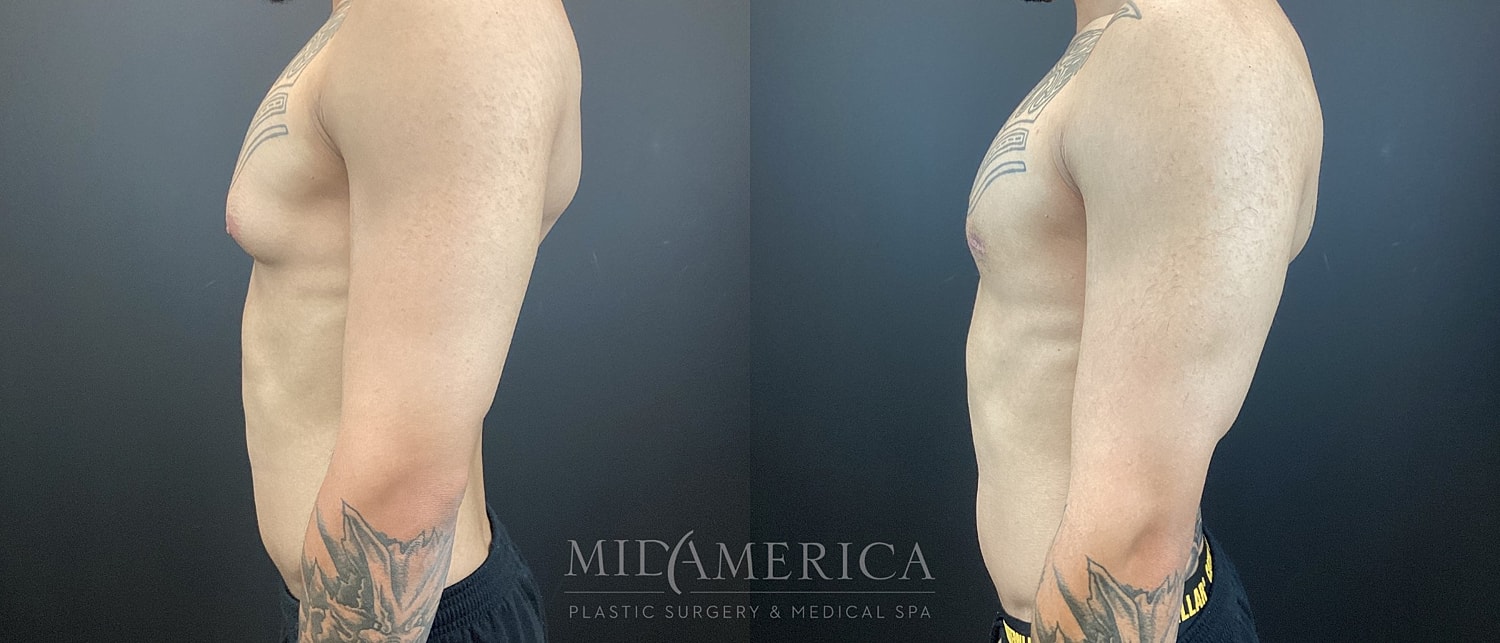 Gynecomastia Before & After