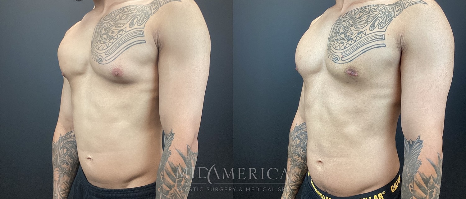 Gynecomastia Before & After