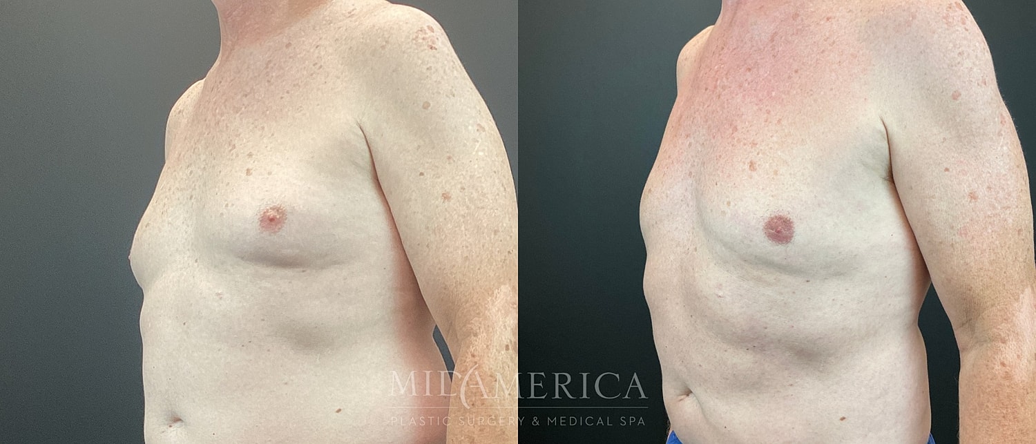 Gynecomastia Before & After