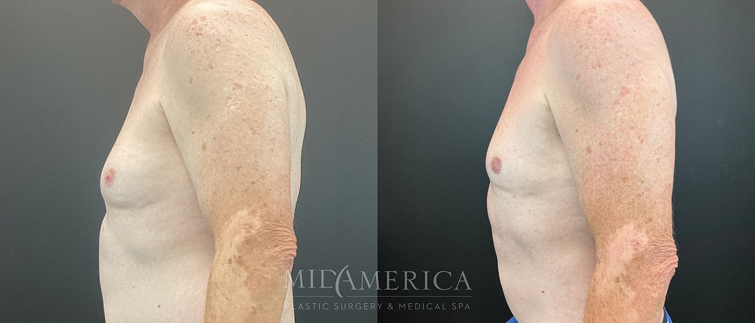 Gynecomastia Before & After