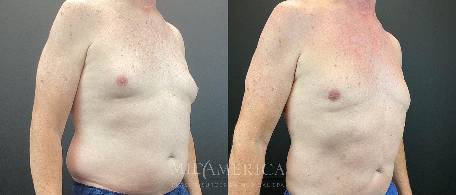 Gynecomastia Before & After