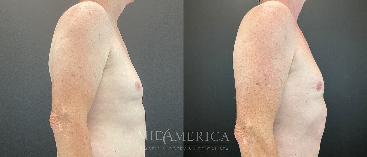 Gynecomastia Before & After