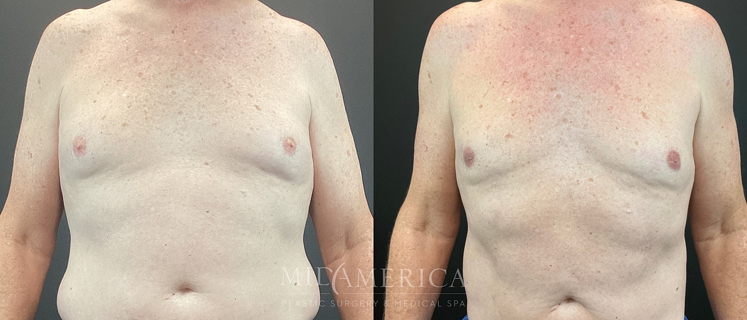 Gynecomastia Before & After