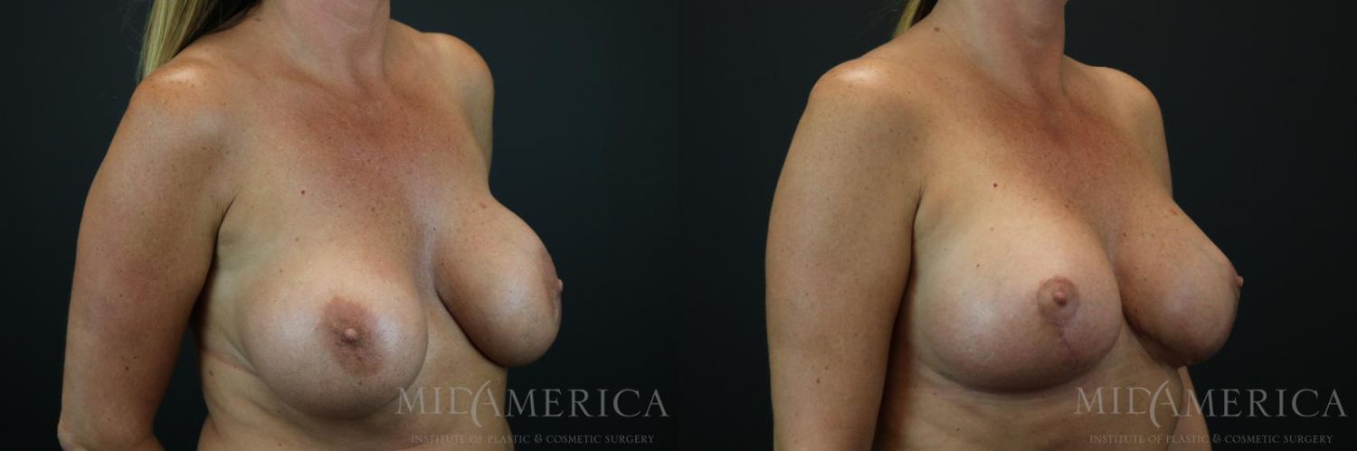 Implant Exchange Before & After