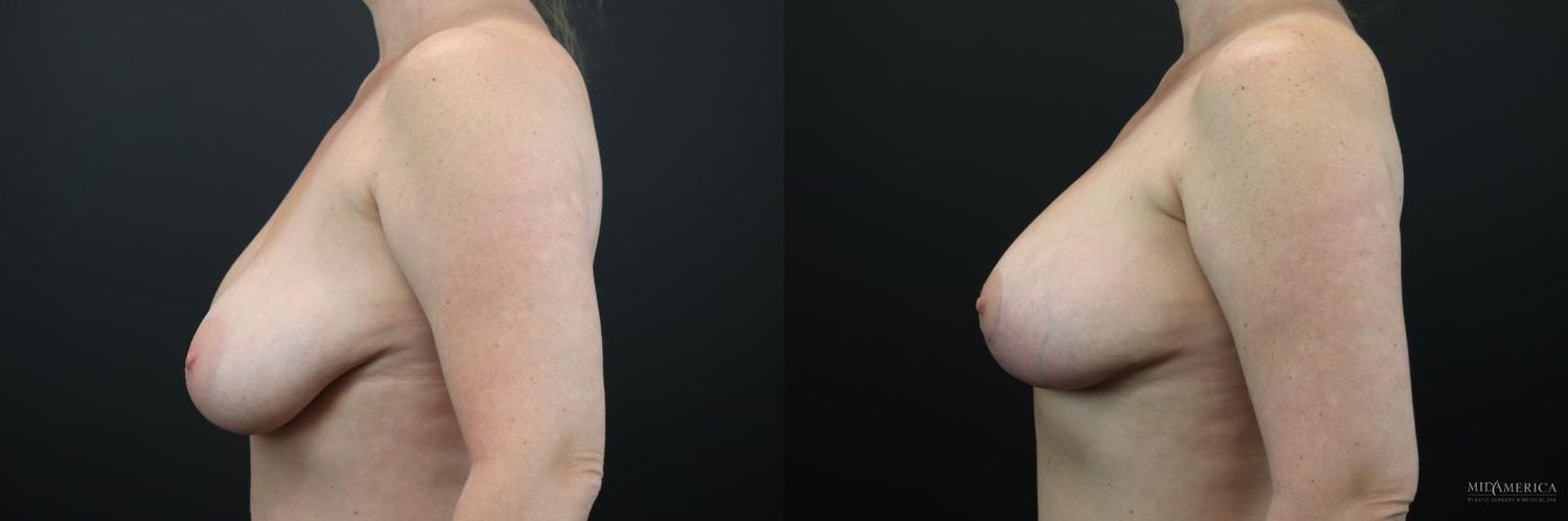 Implant Exchange Before & After