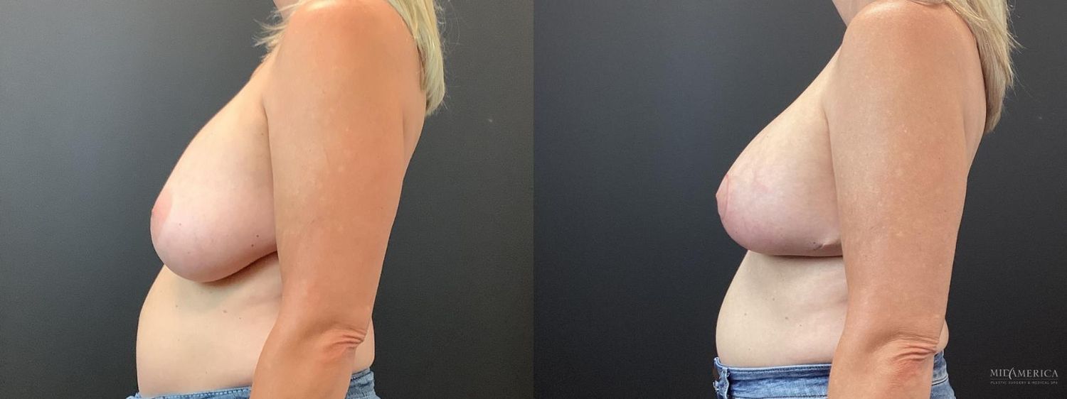 Implant Exchange Before & After