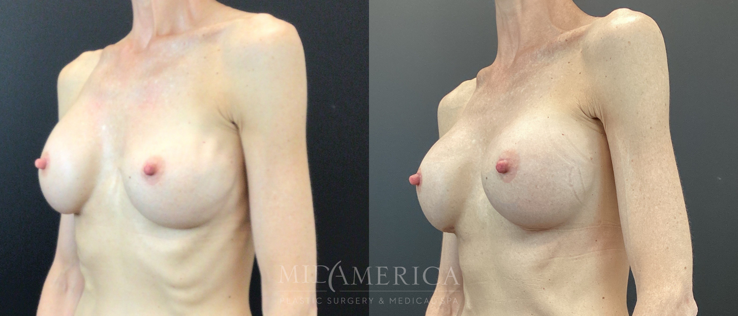 Implant Exchange Before & After