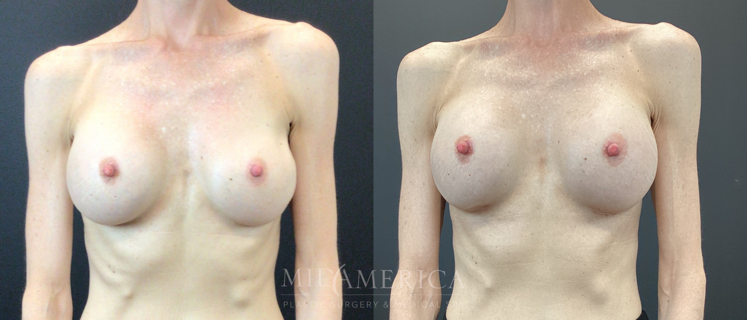 Implant Exchange Before & After