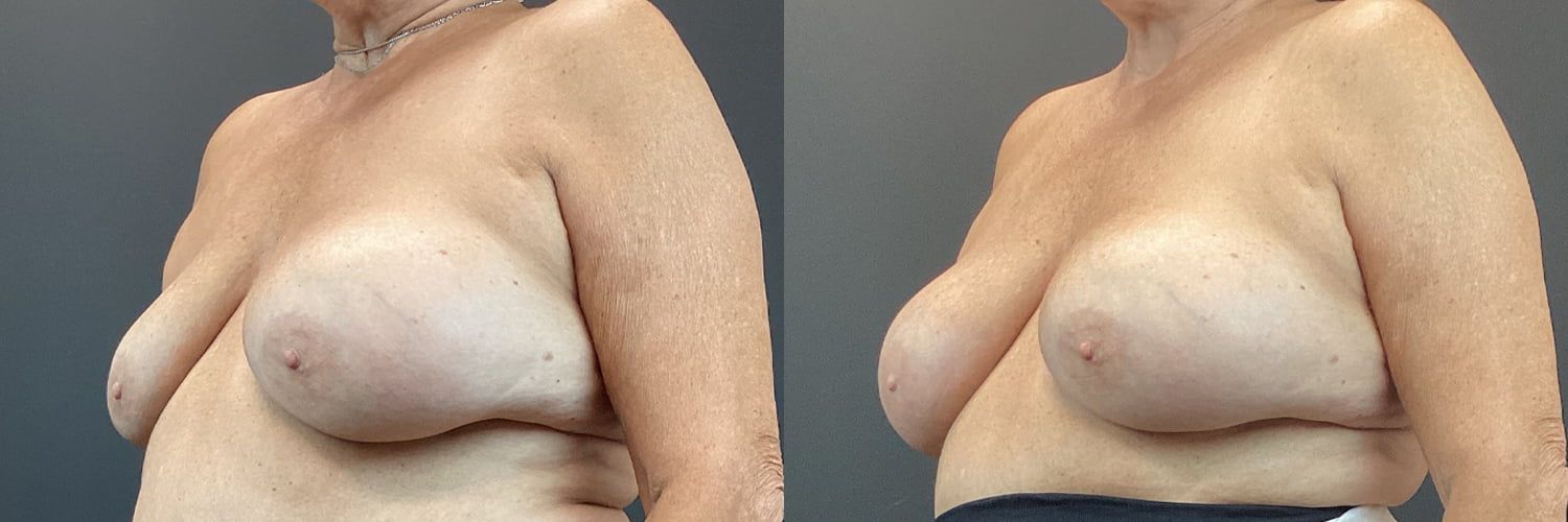 Implant Exchange Before & After