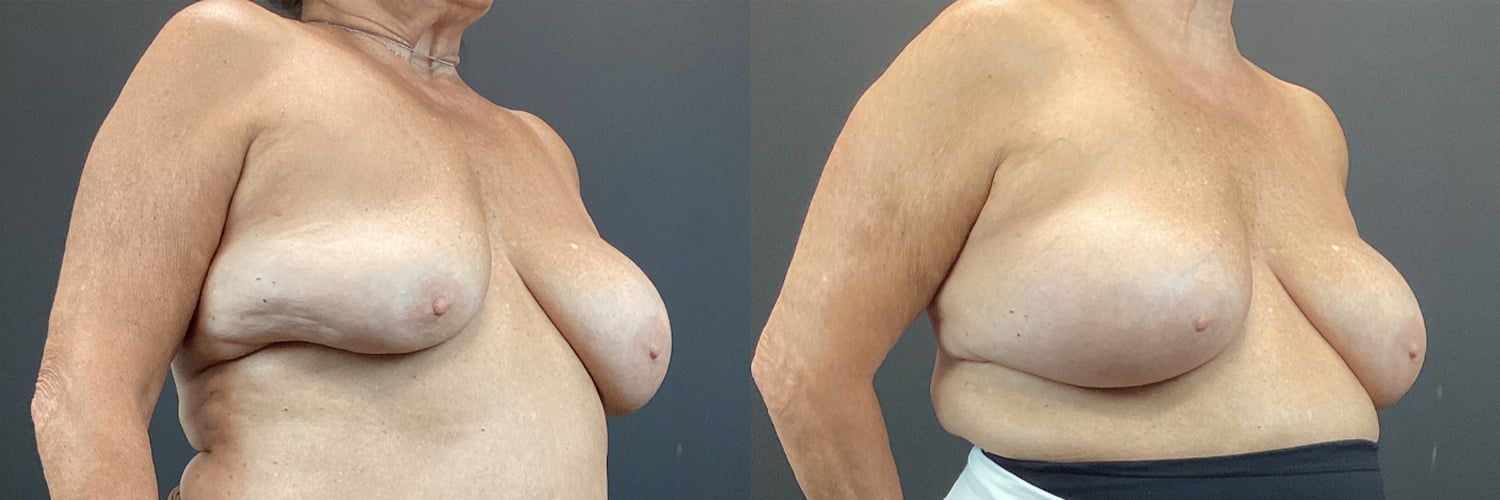 Implant Exchange Before & After