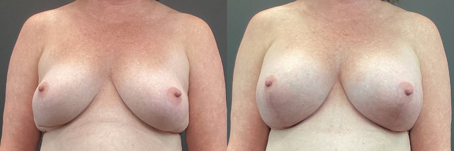 Implant Exchange Before & After