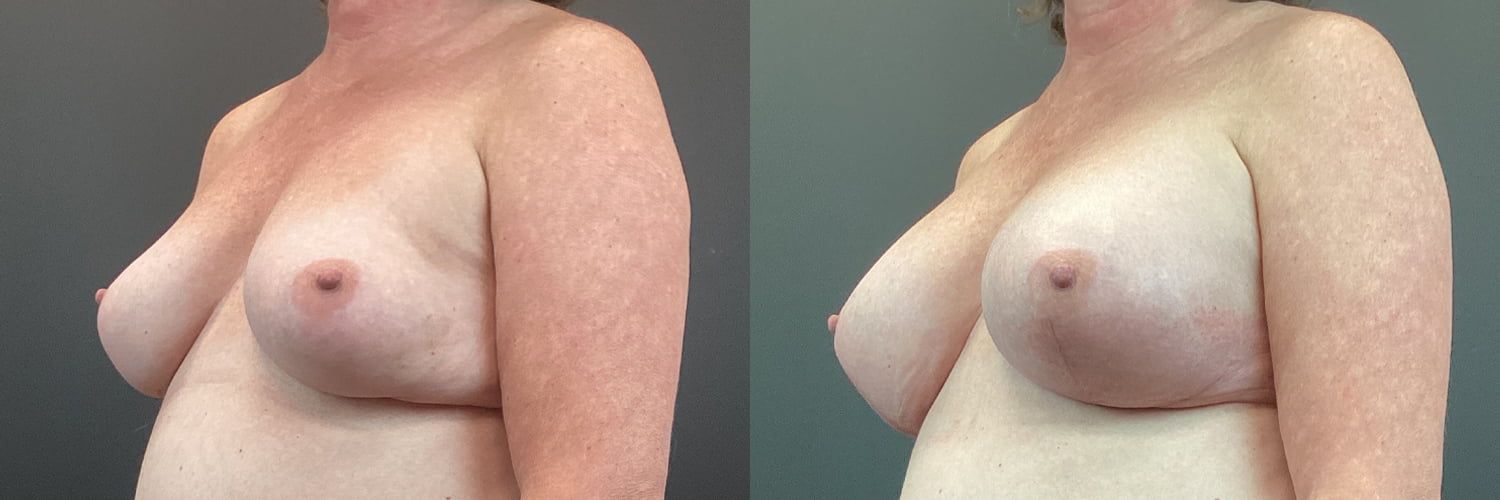 Implant Exchange Before & After