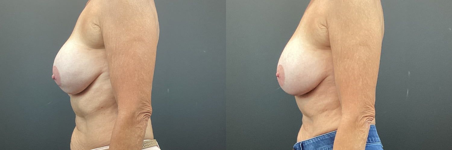 Implant Exchange Before & After