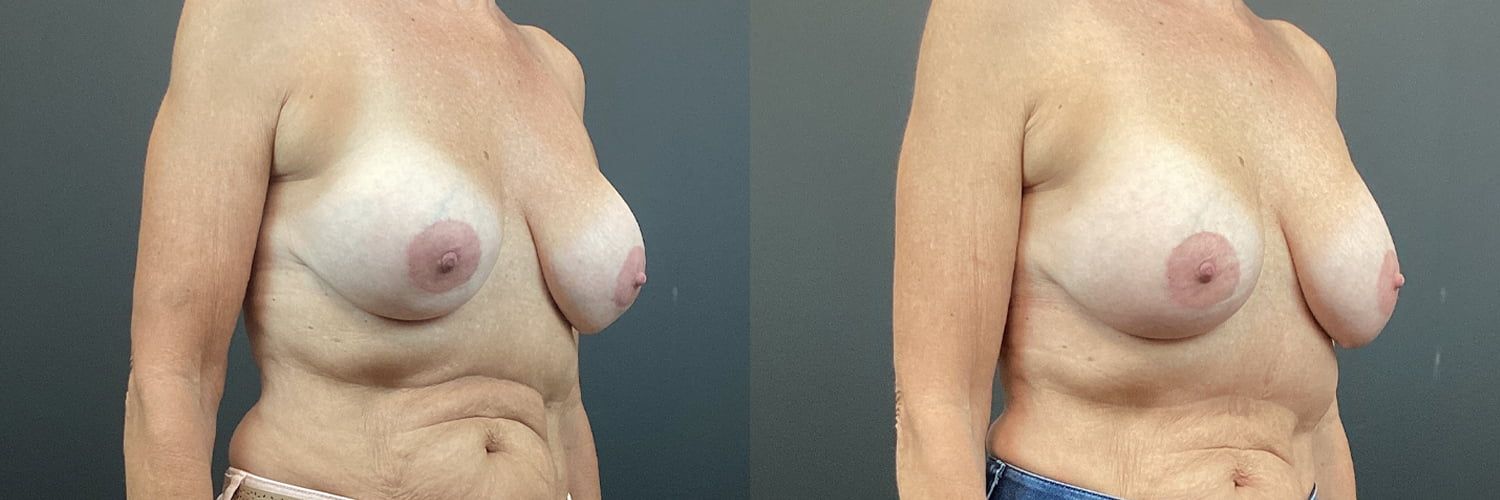 Implant Exchange Before & After