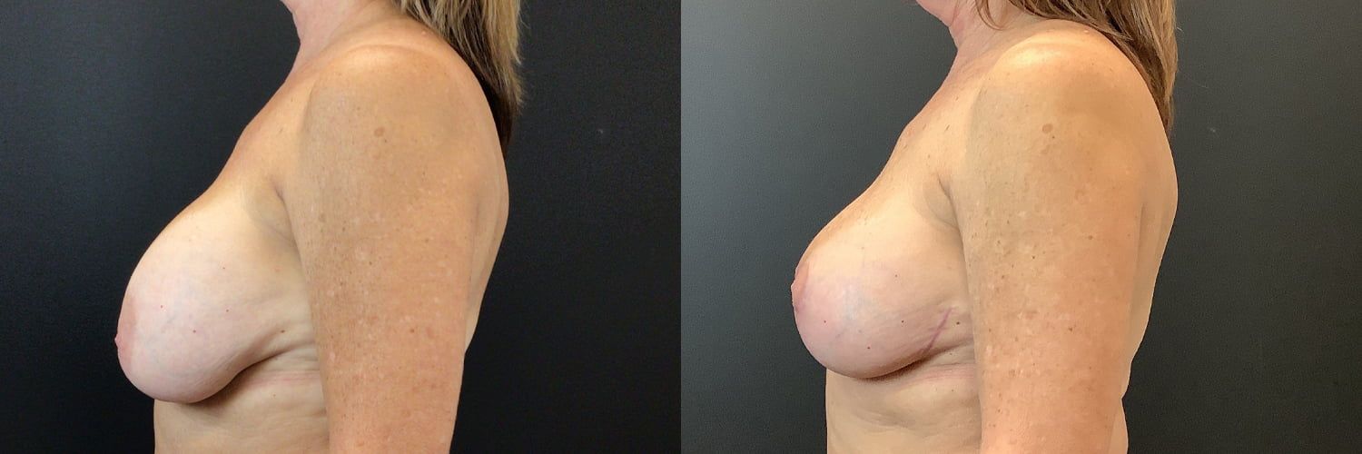 Implant Exchange Before & After