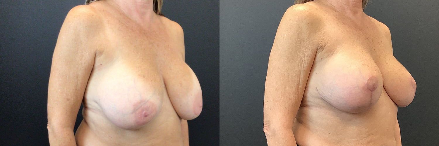 Implant Exchange Before & After