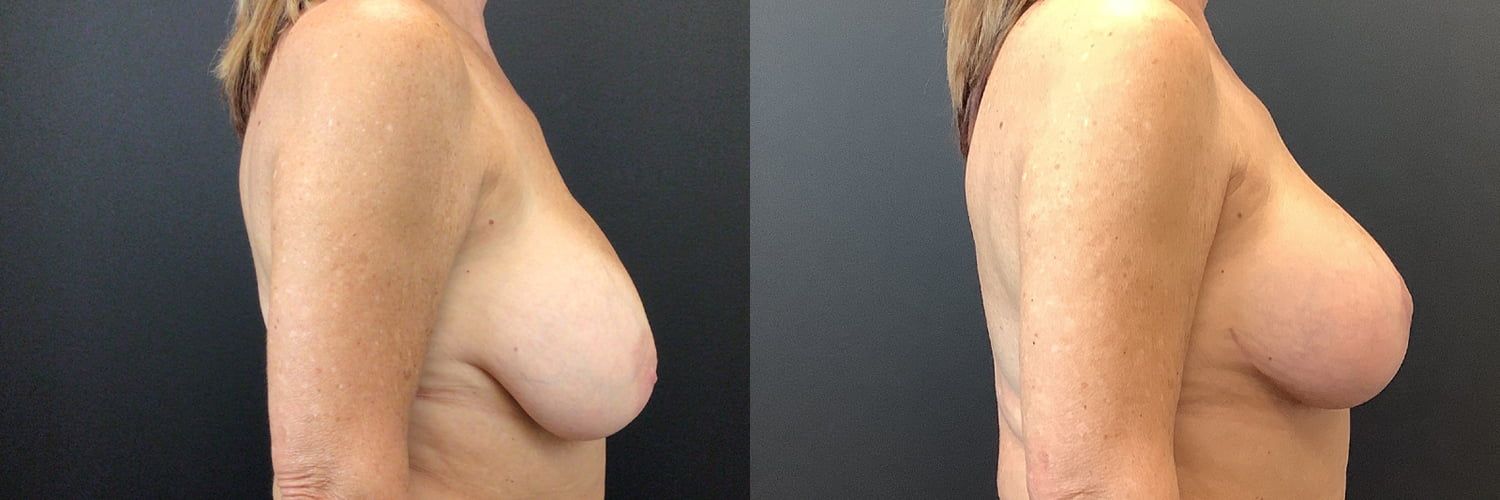 Implant Exchange Before & After