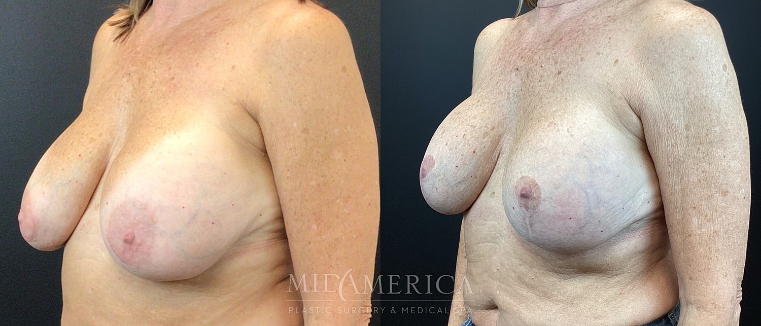 Implant Exchange Before & After