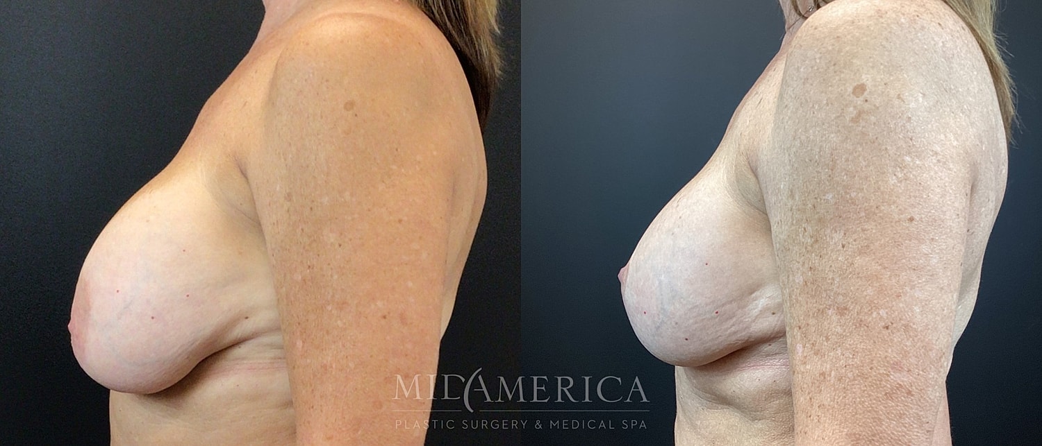 Implant Exchange Before & After