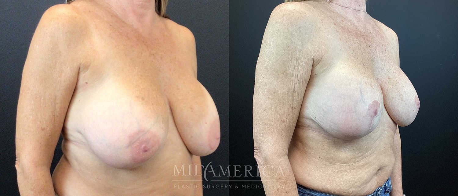 Implant Exchange Before & After