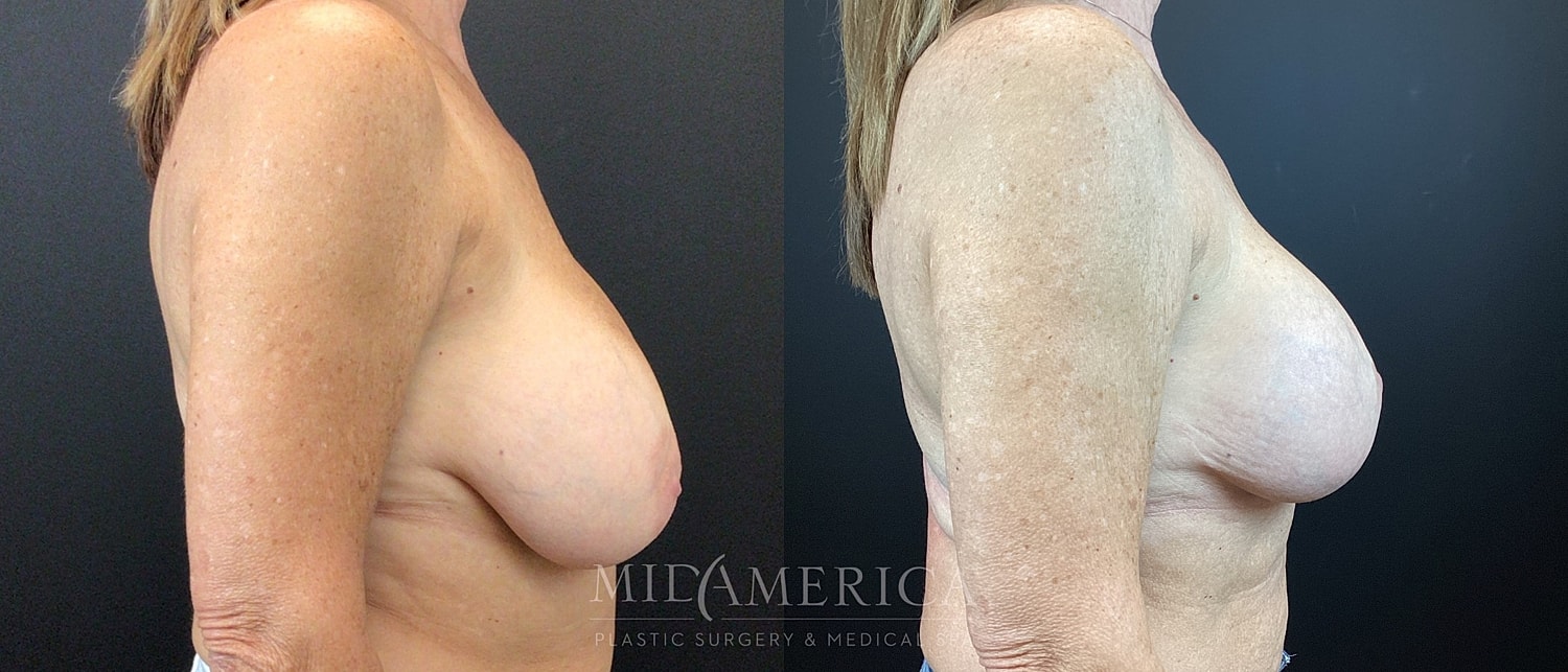 Implant Exchange Before & After