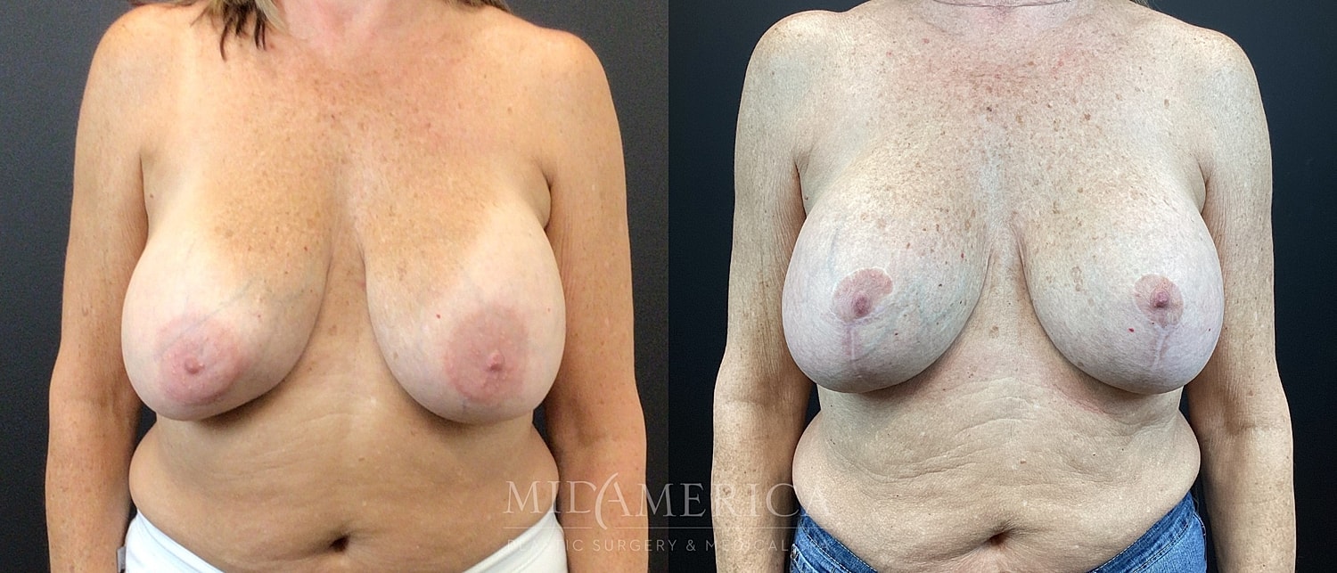 Implant Exchange Before & After