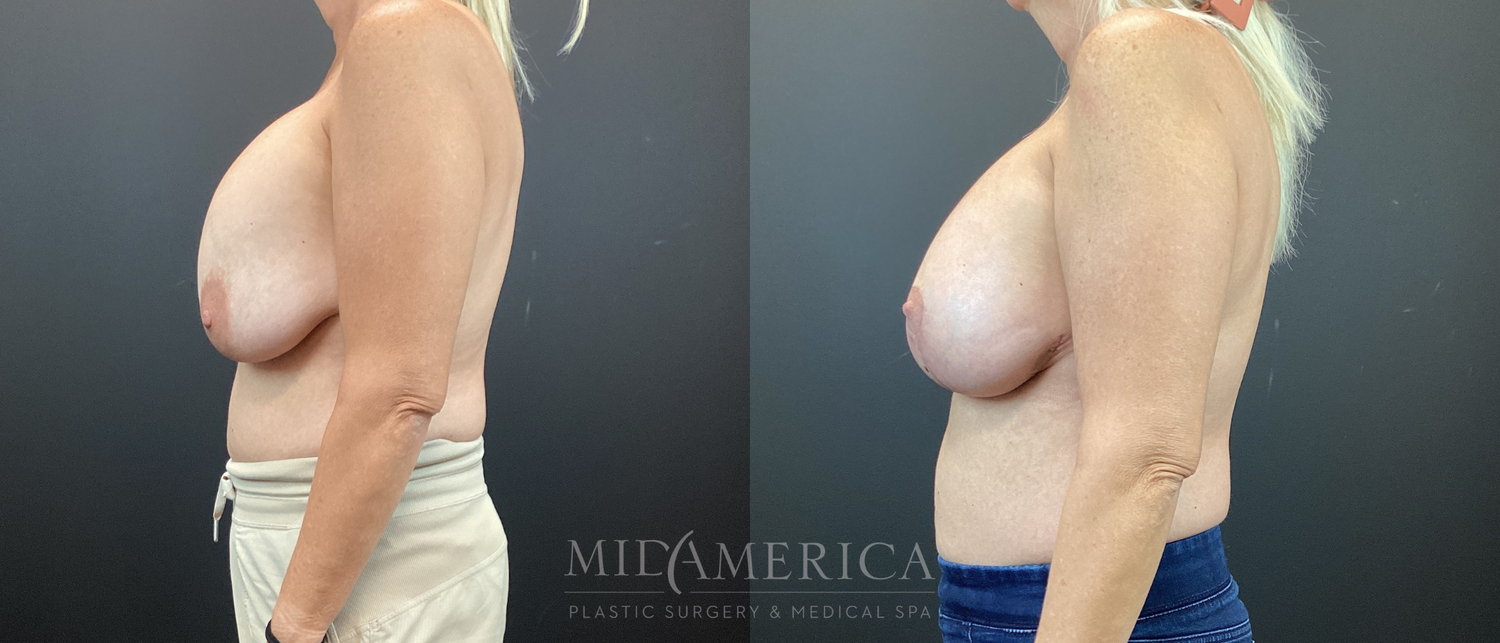 Implant Exchange Before & After