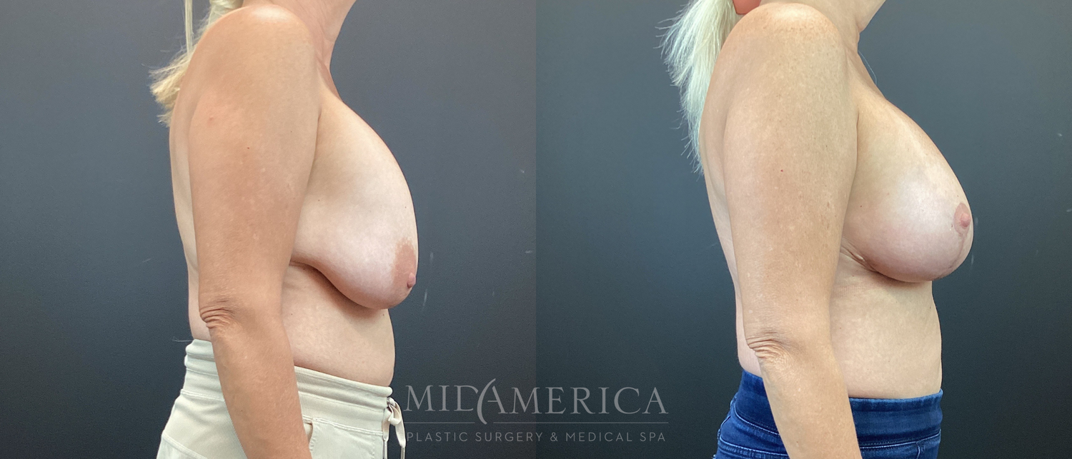 Implant Exchange Before & After