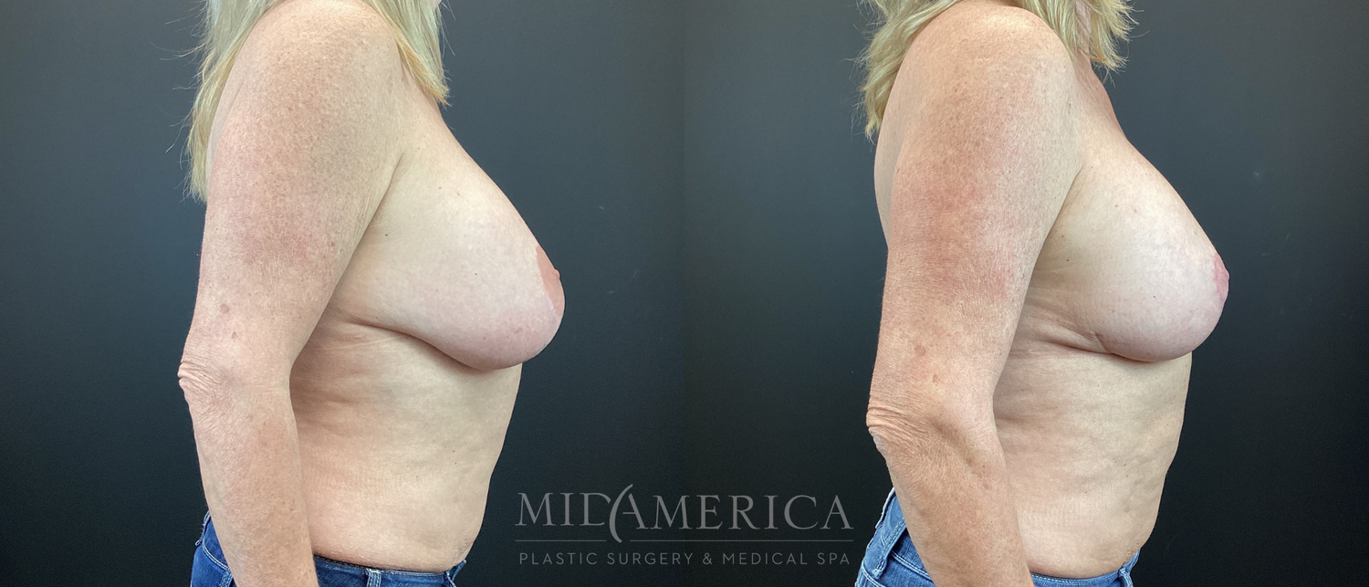 Implant Exchange Before & After