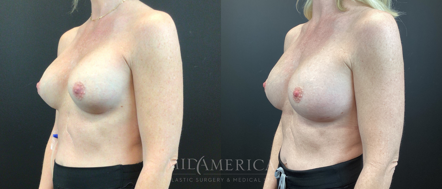 Implant Exchange Before & After