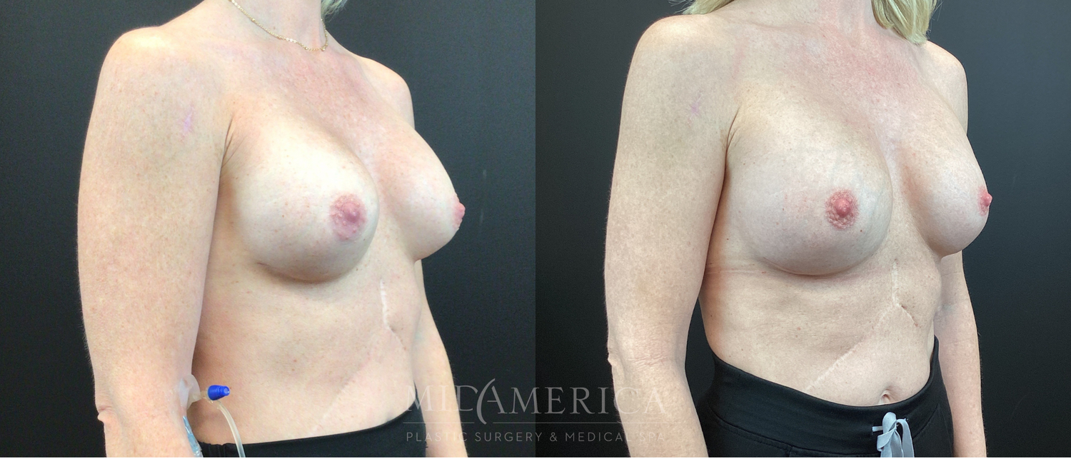 Implant Exchange Before & After