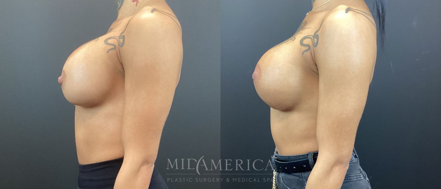 Implant Exchange Before & After