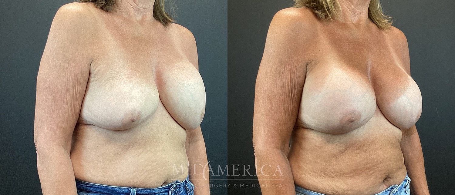 Implant Exchange Before & After