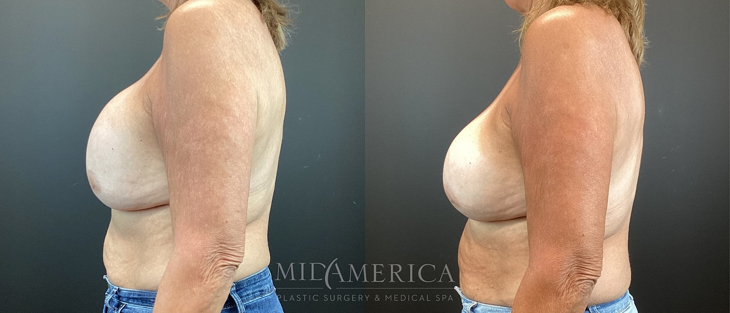 Implant Exchange Before & After