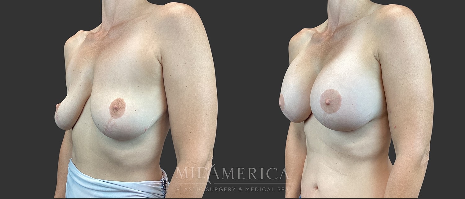 Implant Exchange Before & After