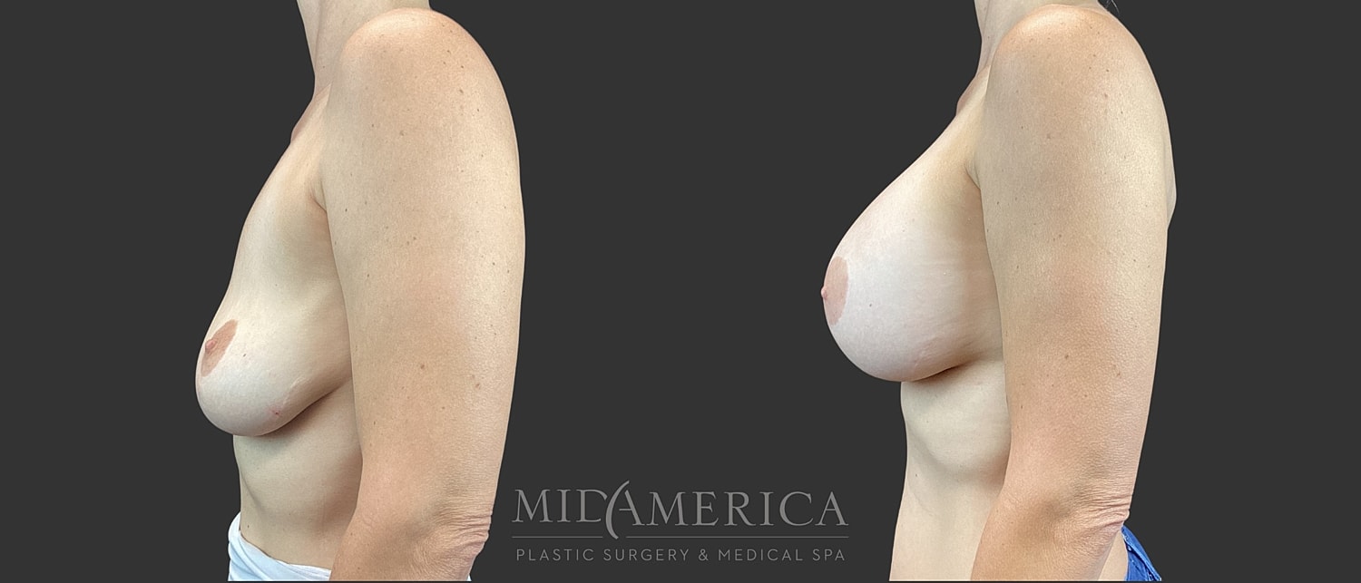 Implant Exchange Before & After