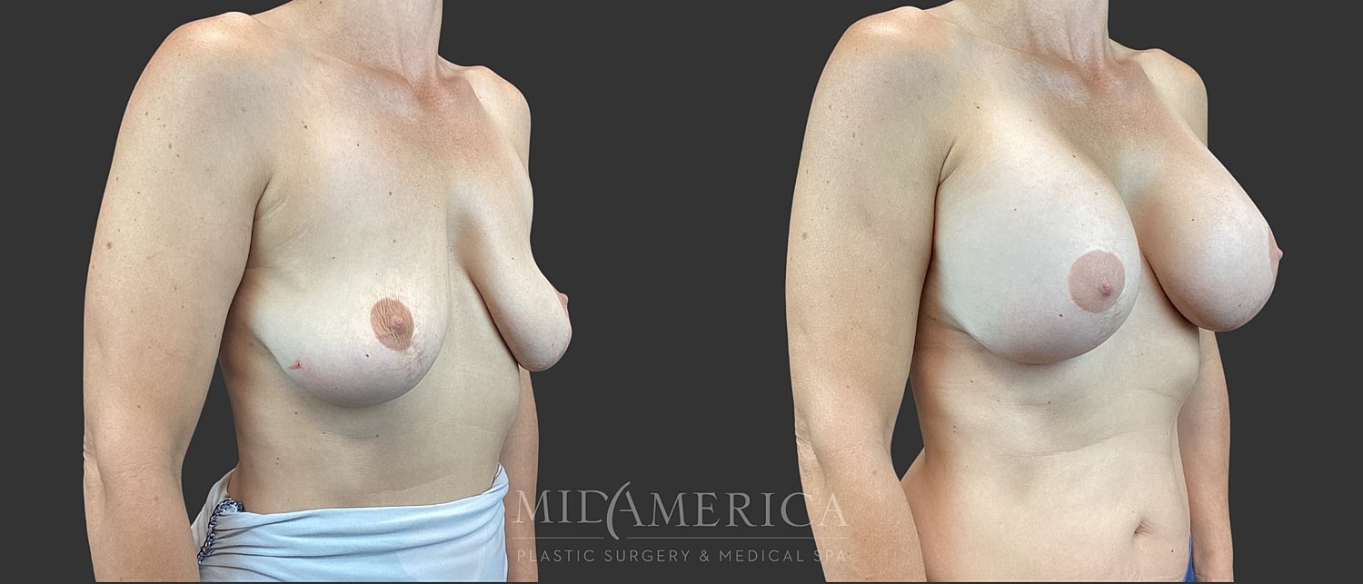 Implant Exchange Before & After