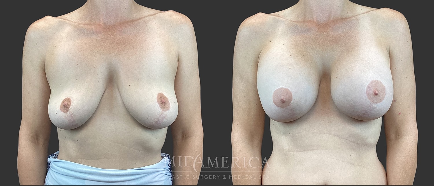 Implant Exchange Before & After