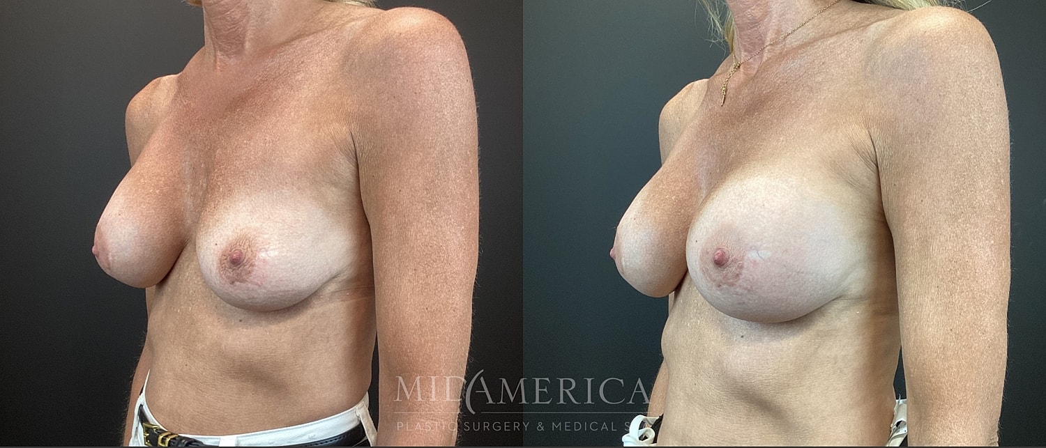 Implant Exchange Before & After