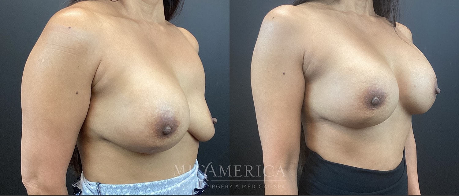 Implant Exchange Before & After